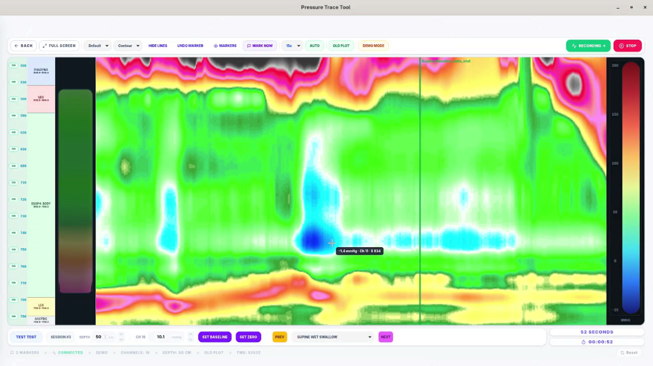Esophageal Manometry System project screenshot
